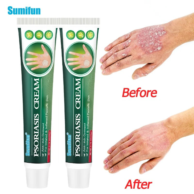 Psoriasis Cream (Original)