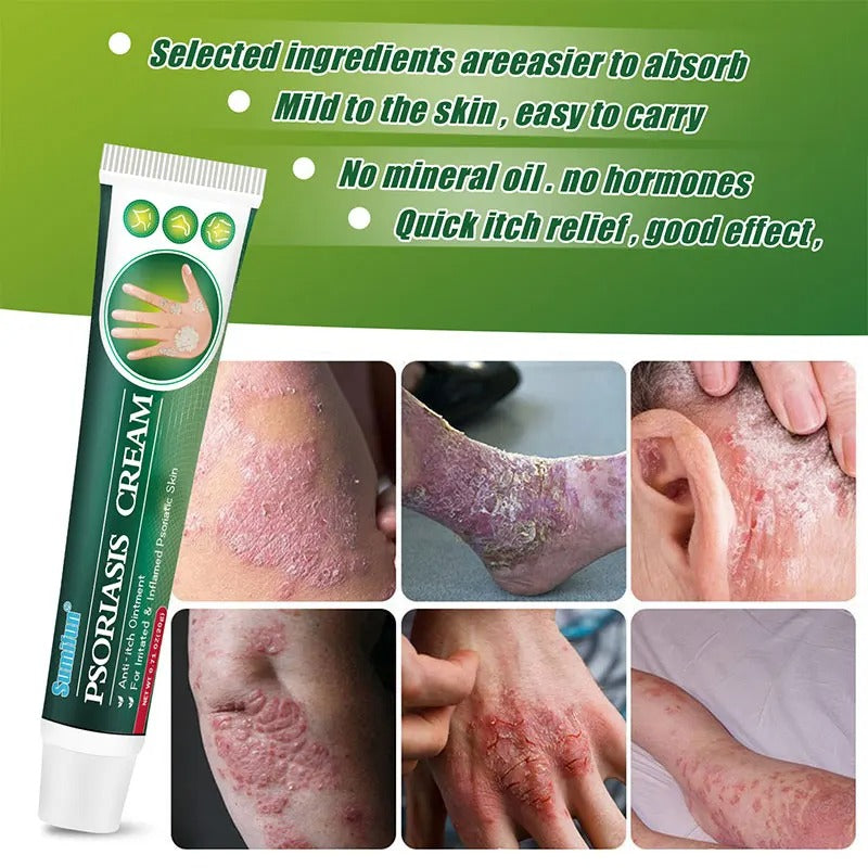 Psoriasis Cream (Original)